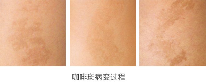 咖啡斑病变